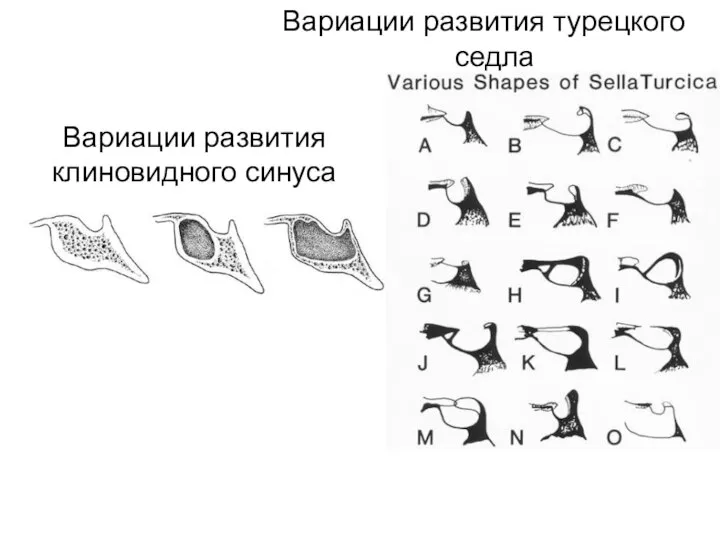 Вариации развития турецкого седла Вариации развития клиновидного синуса