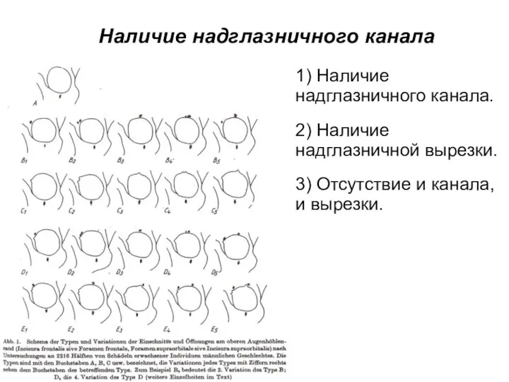 Наличие надглазничного канала 1) Наличие надглазничного канала. 2) Наличие надглазничной вырезки. 3)