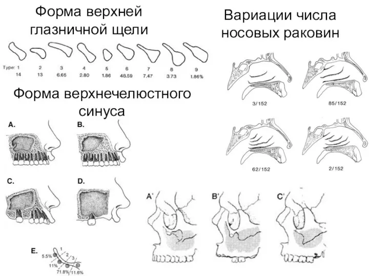 Форма верхней глазничной щели Вариации числа носовых раковин Форма верхнечелюстного синуса