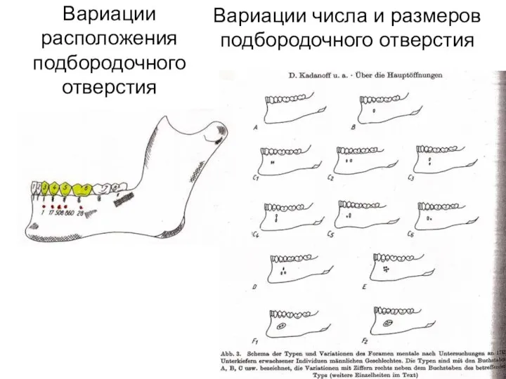 Вариации расположения подбородочного отверстия Вариации числа и размеров подбородочного отверстия