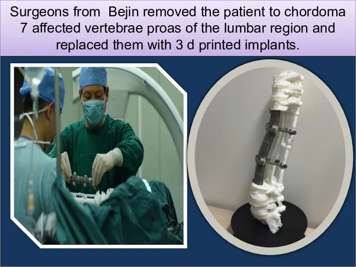 Surgeons from Bejin removed the patient to chordoma 7 affected vertebrae proas