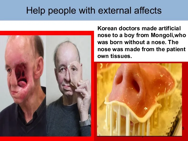 Help people with external affects Korean doctors made artificial nose to a