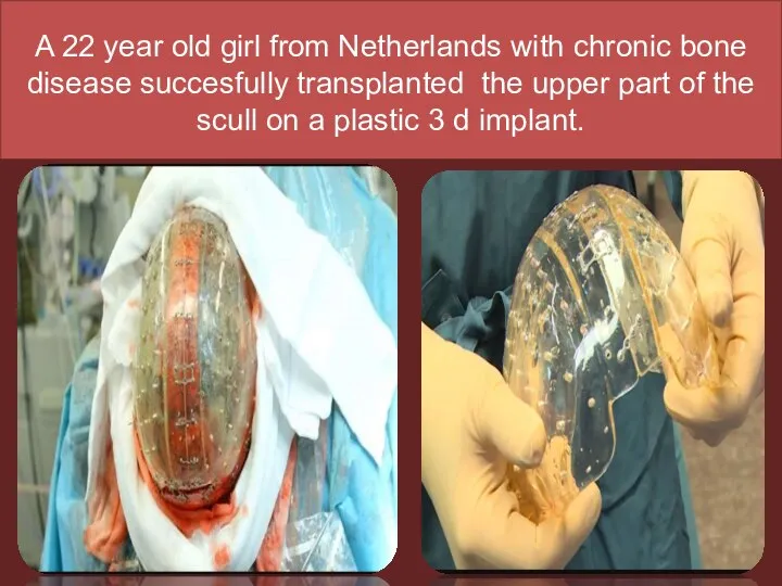 A 22 year old girl from Netherlands with chronic bone disease succesfully