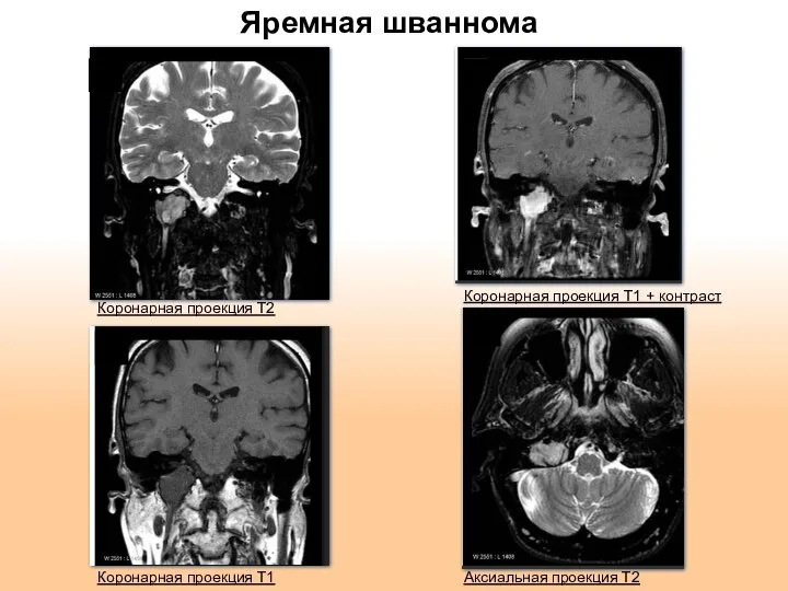 Яремная шваннома Аксиальная проекция Т2 Коронарная проекция Т1 Коронарная проекция Т2 Коронарная проекция Т1 + контраст