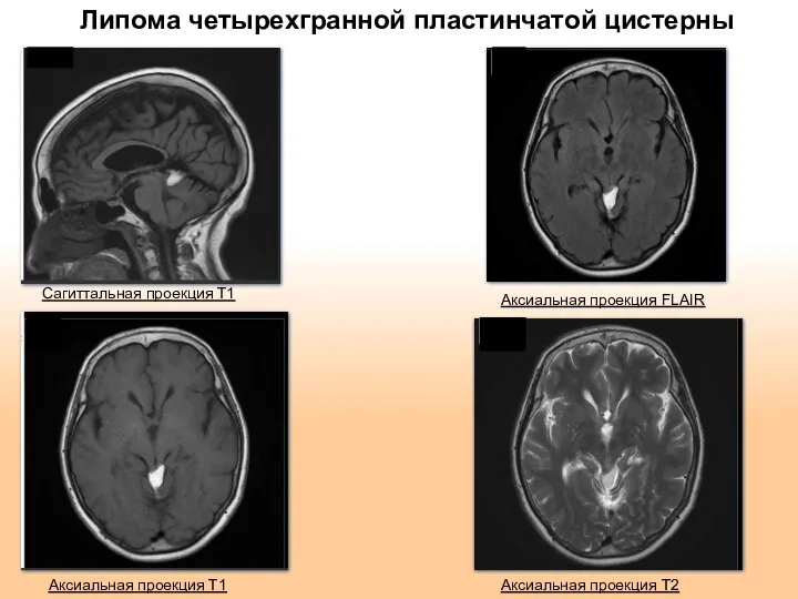 Липома четырехгранной пластинчатой цистерны Аксиальная проекция Т2 Аксиальная проекция FLAIR Аксиальная проекция Т1 Сагиттальная проекция Т1