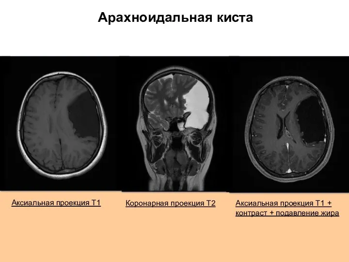 Арахноидальная киста Аксиальная проекция Т1 + контраст + подавление жира Коронарная проекция Т2 Аксиальная проекция Т1