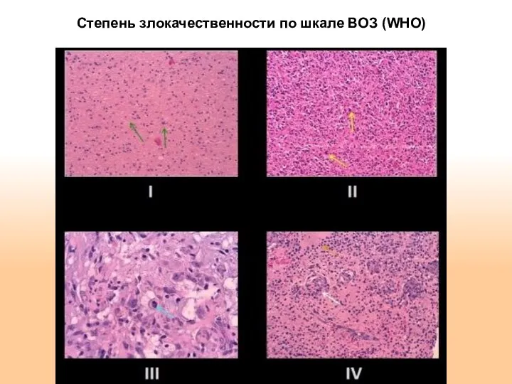 Степень злокачественности по шкале ВОЗ (WHO)