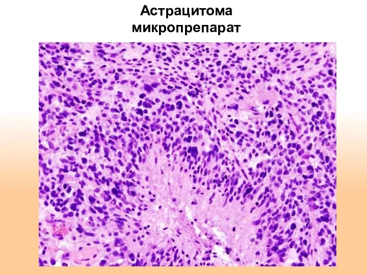 Астрацитома микропрепарат