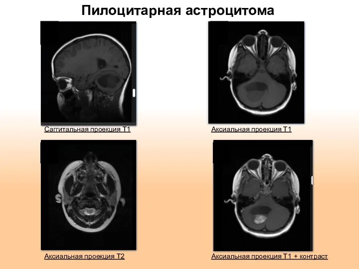 Пилоцитарная астроцитома Саггитальная проекция Т1 Аксиальная проекция Т1 + контраст Аксиальная проекция Т1 Аксиальная проекция Т2