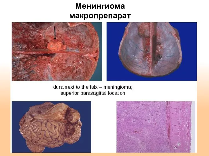 Менингиома макропрепарат