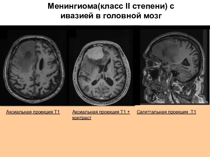 Аксиальная проекция Т1 Сагиттальная проекция Т1 Аксиальная проекция Т1 + контраст Менингиома(класс