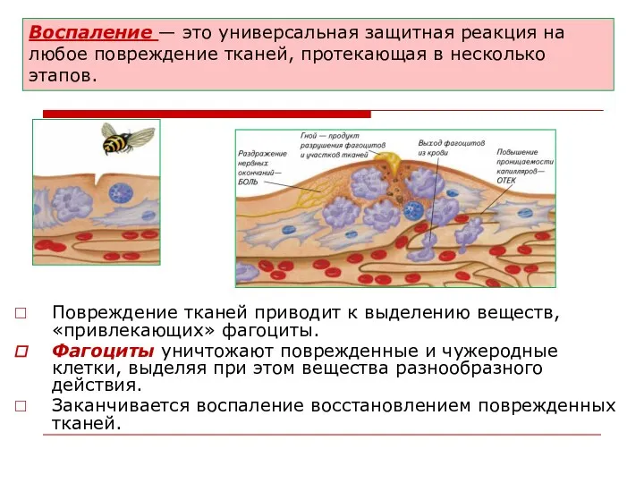 Воспаление — это универсальная защитная реакция на любое повреждение тканей, протекающая в