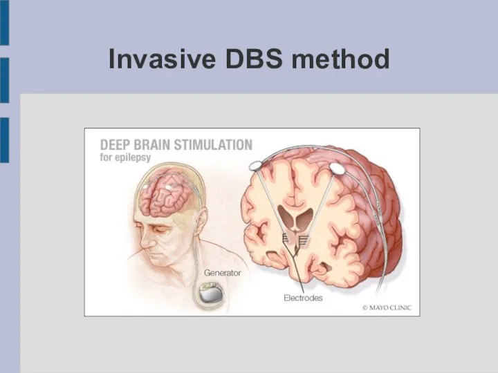 Invasive DBS method