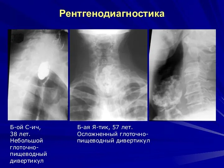 Рентгенодиагностика Б-ая Я-тик, 57 лет. Осложненный глоточно-пищеводный дивертикул Б-ой С-ич, 38 лет. Небольшой глоточно-пищеводный дивертикул