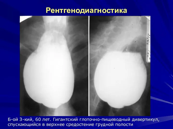 Рентгенодиагностика Б-ой З-кий, 60 лет. Гигантский глоточно-пищеводный дивертикул, спускающийся в верхнее средостение грудной полости