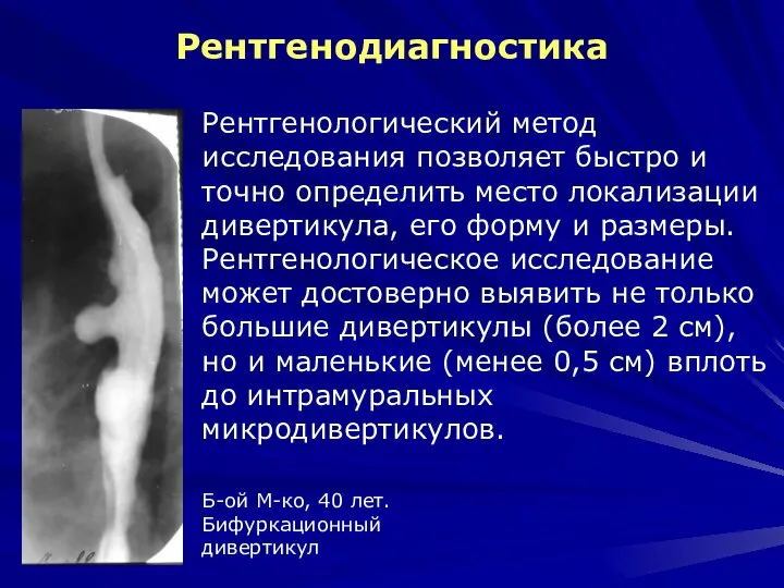 Рентгенодиагностика Рентгенологический метод исследования позволяет быстро и точно определить место локализации дивертикула,