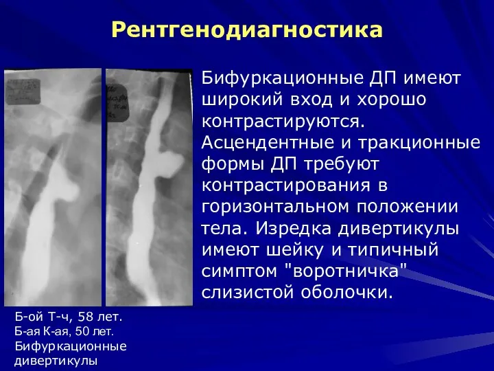 Рентгенодиагностика Бифуркационные ДП имеют широкий вход и хорошо контрастируются. Асцендентные и тракционные