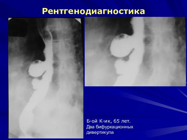 Рентгенодиагностика Б-ой К-ик, 65 лет. Два бифуркационных дивертикула