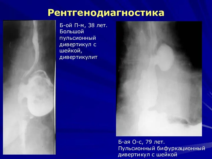 Рентгенодиагностика Б-ой П-м, 38 лет. Большой пульсионный дивертикул с шейкой, дивертикулит Б-ая