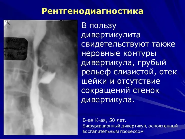 Рентгенодиагностика В пользу дивертикулита свидетельствуют также неровные контуры дивертикула, грубый рельеф слизистой,