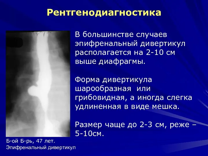 Рентгенодиагностика В большинстве случаев эпифренальный дивертикул располагается на 2-10 см выше диафрагмы.