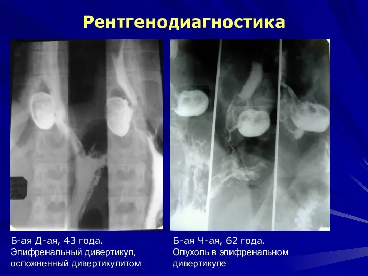 Рентгенодиагностика Б-ая Д-ая, 43 года. Эпифренальный дивертикул, осложненный дивертикулитом Б-ая Ч-ая, 62