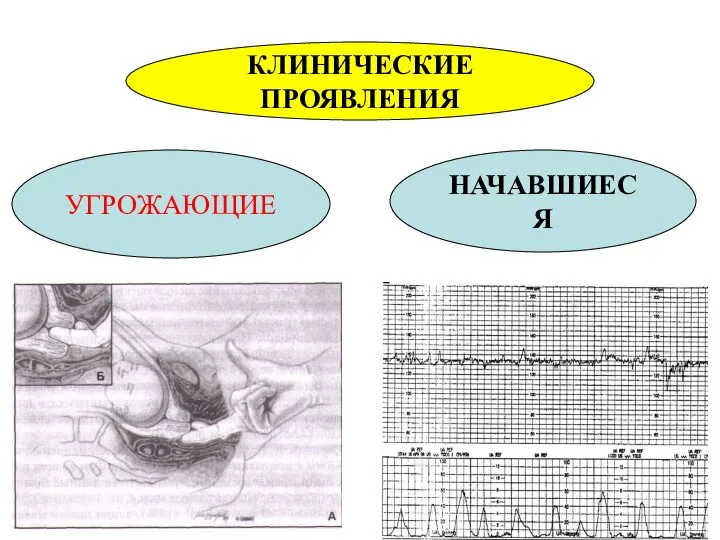 КЛИНИЧЕСКИЕ ПРОЯВЛЕНИЯ УГРОЖАЮЩИЕ НАЧАВШИЕСЯ