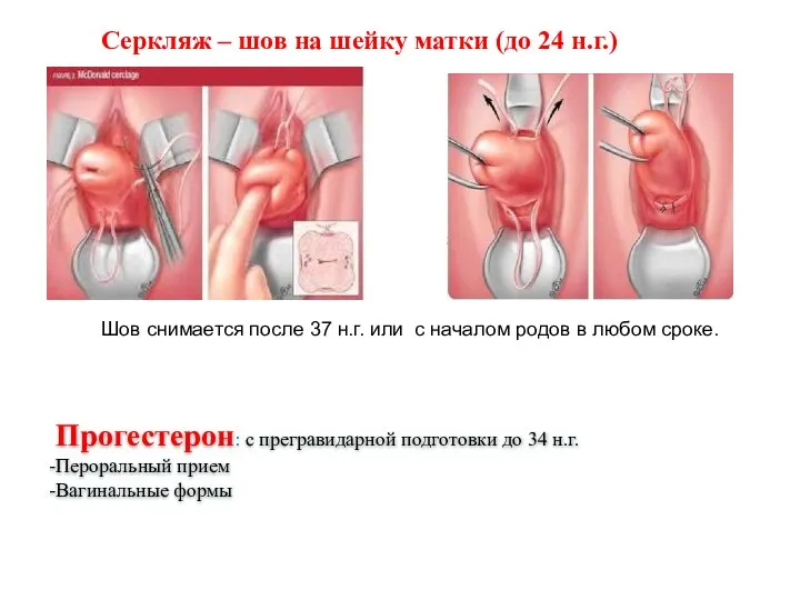 Серкляж – шов на шейку матки (до 24 н.г.) Шов снимается после