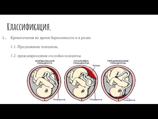 Классификация. Кровотечения во время беременности и в родах 1.1. Предлежание плаценты, 1.2. преждевременная отслойка плаценты.