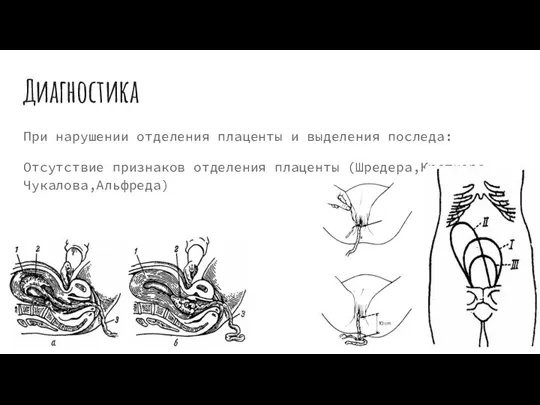 Диагностика При нарушении отделения плаценты и выделения последа: Отсутствие признаков отделения плаценты (Шредера,Кюстнера-Чукалова,Альфреда)