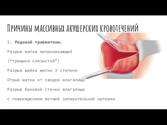 Причины массивных акушерских кровотечений 2. Родовой травматизм. Разрыв матки непроникающий (“трещина слизистой”)