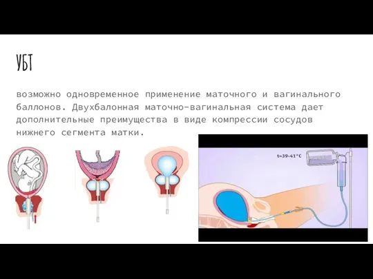УБТ возможно одновременное применение маточного и вагинального баллонов. Двухбалонная маточно-вагинальная система дает