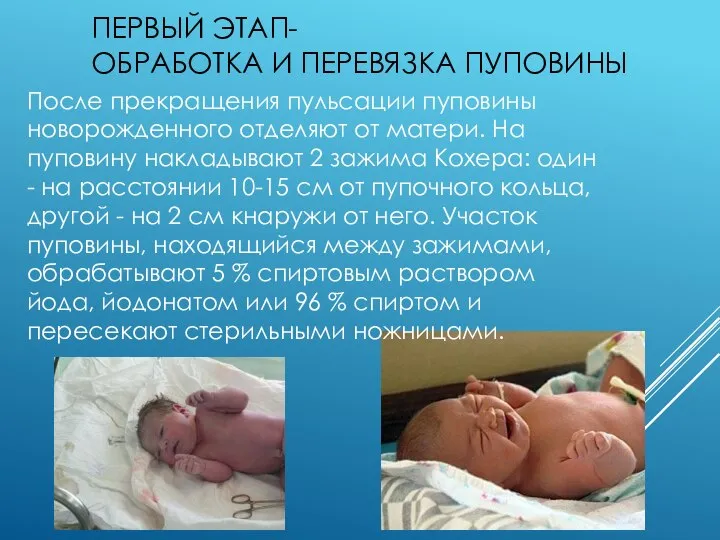 ПЕРВЫЙ ЭТАП- ОБРАБОТКА И ПЕРЕВЯЗКА ПУПОВИНЫ После прекращения пульсации пуповины новорожденного отделяют