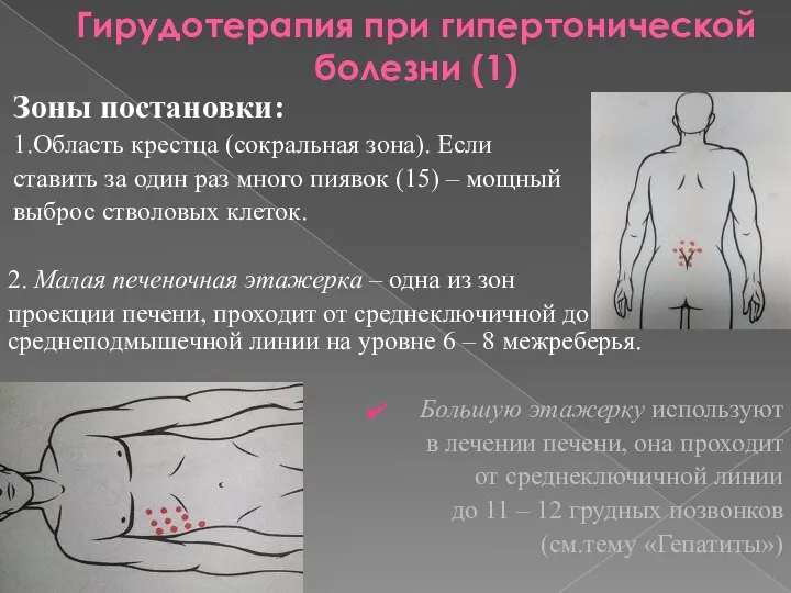 Гирудотерапия при гипертонической болезни (1) Зоны постановки: 1.Область крестца (сокральная зона). Если