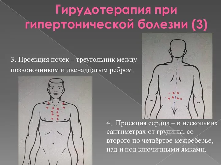 Гирудотерапия при гипертонической болезни (3) 3. Проекция почек – треугольник между позвоночником