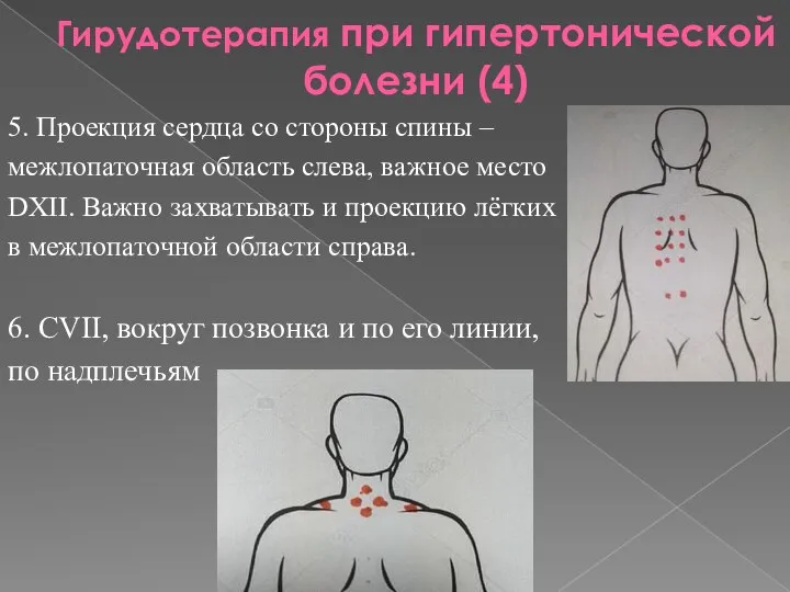 Гирудотерапия при гипертонической болезни (4) 5. Проекция сердца со стороны спины –