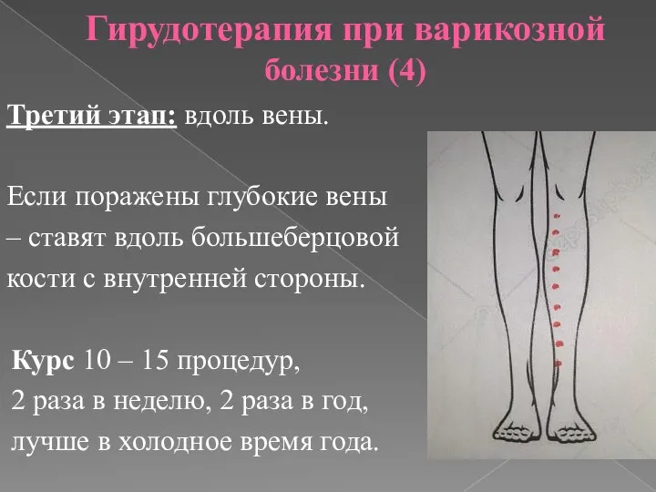 Гирудотерапия при варикозной болезни (4) Третий этап: вдоль вены. Если поражены глубокие