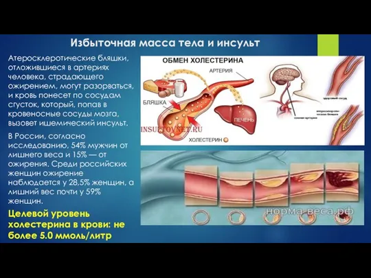 Избыточная масса тела и инсульт Атеросклеротические бляшки, отложившиеся в артериях человека, страдающего