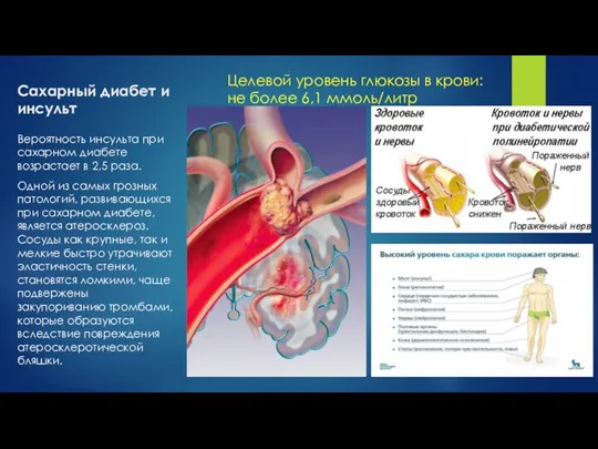 Сахарный диабет и инсульт Вероятность инсульта при сахарном диабете возрастает в 2,5