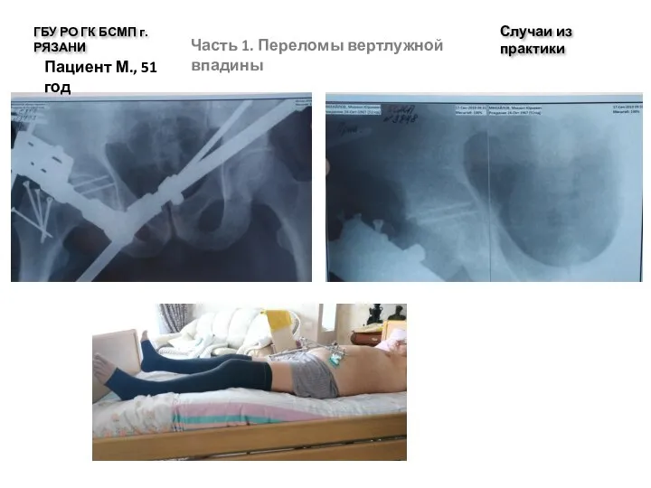 Случаи из практики ГБУ РО ГК БСМП г. РЯЗАНИ Часть 1. Переломы