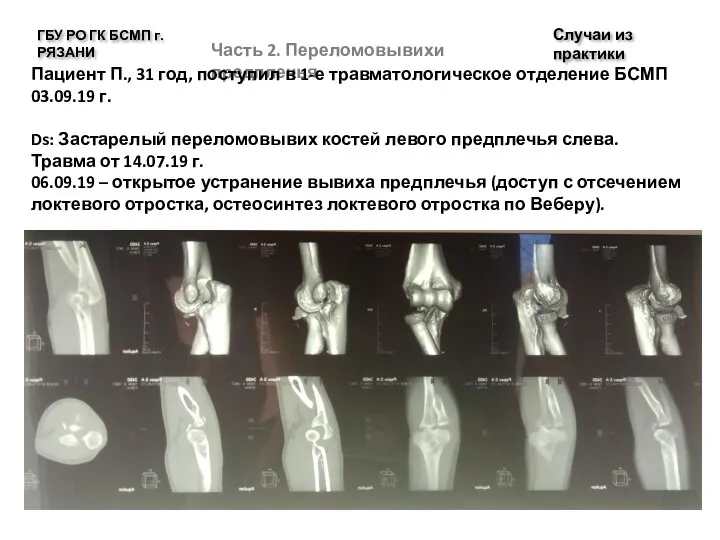 Случаи из практики ГБУ РО ГК БСМП г. РЯЗАНИ Часть 2. Переломовывихи