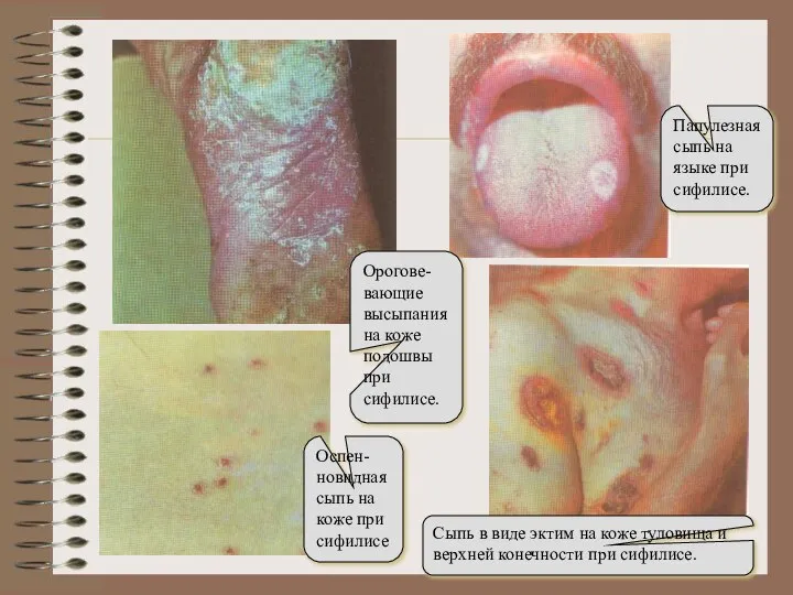 Орогове-вающие высыпания на коже подошвы при сифилисе. Оспен-новидная сыпь на коже при