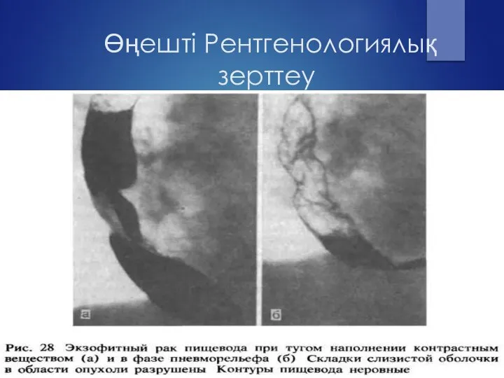 Өңешті Рентгенологиялық зерттеу