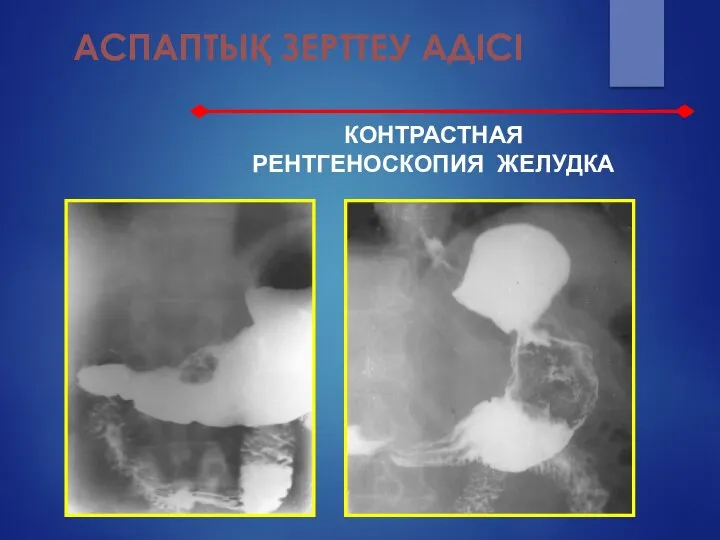 АСПАПТЫҚ ЗЕРТТЕУ АДІСІ КОНТРАСТНАЯ РЕНТГЕНОСКОПИЯ ЖЕЛУДКА