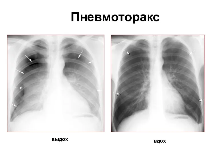 Пневмоторакс вдох выдох