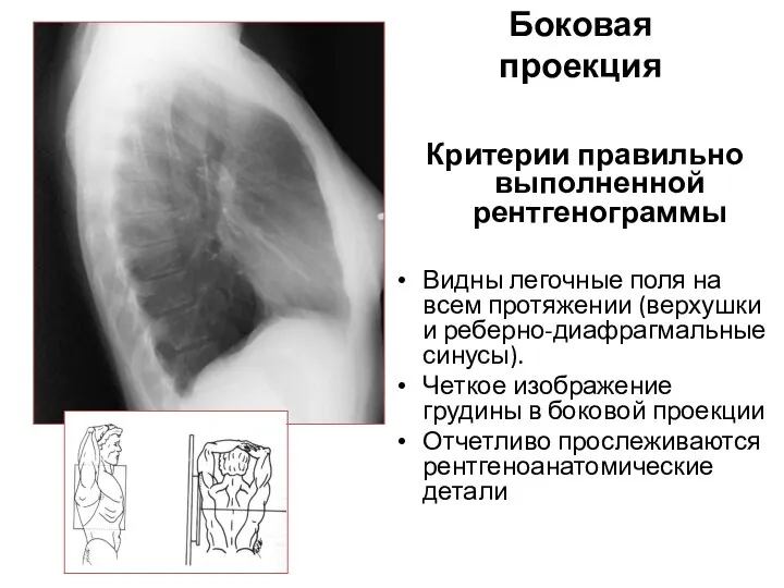 Боковая проекция Критерии правильно выполненной рентгенограммы Видны легочные поля на всем протяжении