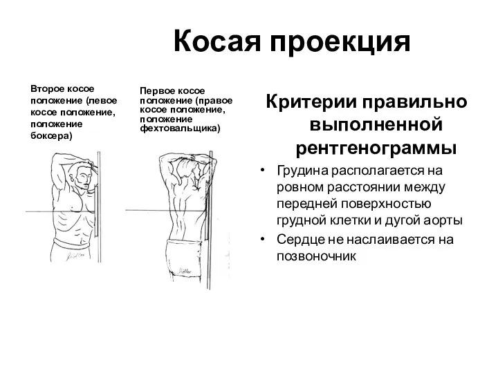 Косая проекция Критерии правильно выполненной рентгенограммы Грудина располагается на ровном расстоянии между