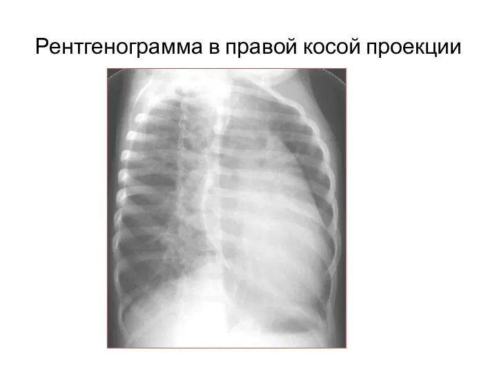Рентгенограмма в правой косой проекции