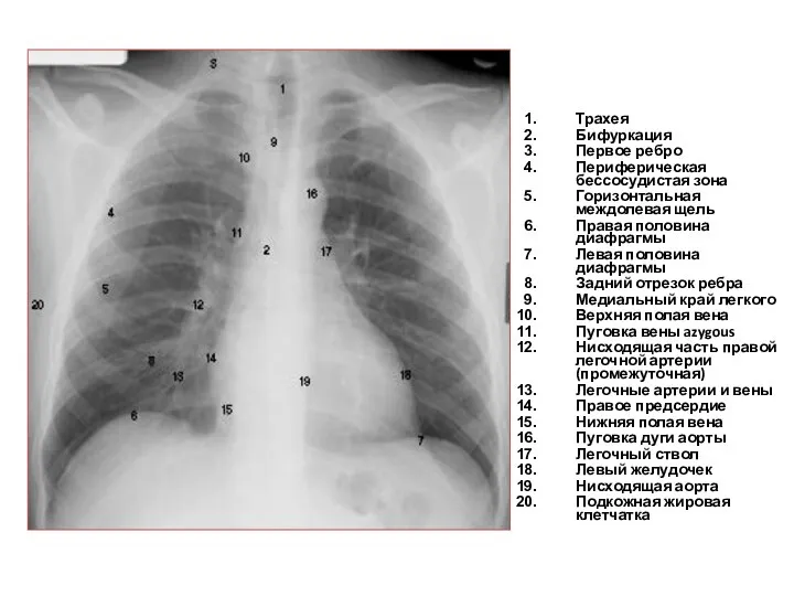 Трахея Бифуркация Первое ребро Периферическая бессосудистая зона Горизонтальная междолевая щель Правая половина