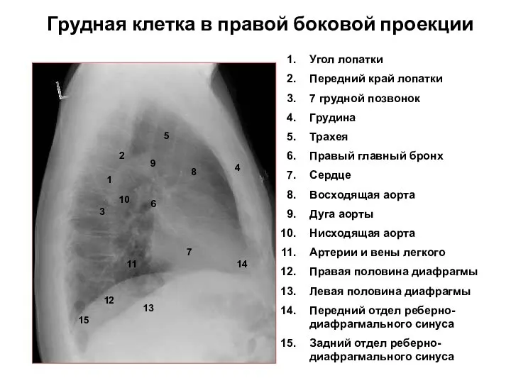 Грудная клетка в правой боковой проекции 1 2 3 4 5 6